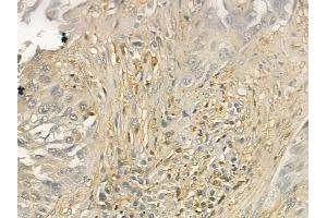ABIN6260596 and ABIN6277004 at 1/100 staining human lung squamous cell carcinoma by IHC-P. (2B4 anticorps  (N-Term))