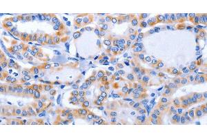 Immunohistochemistry of paraffin-embedded Human thyroid cancer using GFER Polyclonal Antibody at dilution of 1:50
