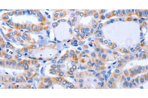 Immunohistochemistry of paraffin-embedded Human thyroid cancer using GFER Polyclonal Antibody at dilution of 1:50 (GFER anticorps)