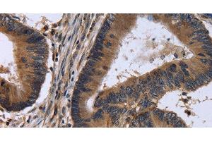 Immunohistochemistry of paraffin-embedded Human colon cancer tissue using FSTL1 Polyclonal Antibody at dilution 1:30 (FSTL1 anticorps)
