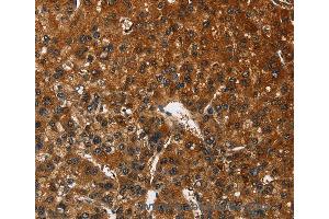 Immunohistochemistry of Human gastric cancer using CATSPER4 Polyclonal Antibody at dilution of 1:50 (CATSPER4 anticorps)