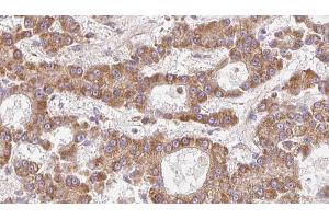 ABIN6273974 at 1/100 staining Human liver cancer tissue by IHC-P. (OR1L4/1L6 anticorps)