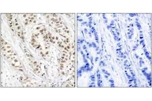 Immunohistochemistry analysis of paraffin-embedded human breast carcinoma, using BRCA1 (Phospho-Ser1524) Antibody. (BRCA1 anticorps  (pSer1524))