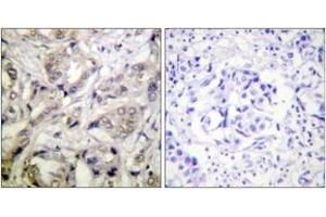 Immunohistochemistry analysis of paraffin-embedded human breast carcinoma tissue, using CaMK1-alpha (Ab-177) Antibody. (CAMK1 anticorps  (AA 143-192))