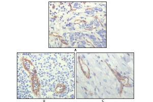 Immunohistochemical analysis of paraffin-embedded human lung cancer (A), lymphonodus tissue (B) and breast cancer (C), showing cytoplasmic localization of vascular endothelial cells using CD31 mouse mAb with DAB staining.