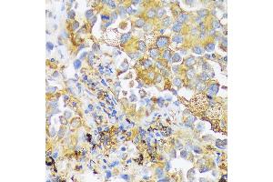 Immunohistochemistry of paraffin-embedded human lung cancer using ZDHHC18 antibody (ABIN7271549) at dilution of 1:100 (40x lens).