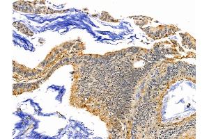 SLFN11 Antibody at 1/100 staining Human colorectal cancer by IHC-P. (SLFN11 anticorps  (N-Term))