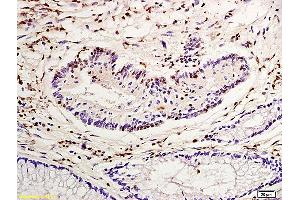 Formalin-fixed and paraffin embedded human colon carcinoma labeled with Anti-Nucleophosmin Polyclonal Antibody, Unconjugated (ABIN1387533) at 1:200 followed by conjugation to the secondary antibody and DAB staining