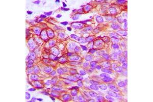 Immunohistochemical analysis of Claudin 1 staining in human breast cancer formalin fixed paraffin embedded tissue section.