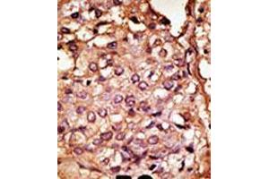 Formalin-fixed and paraffin-embedded human cancer tissue reacted with the primary antibody, which was peroxidase-conjugated to the secondary antibody, followed by AEC staining.