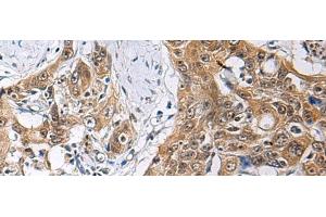 Immunohistochemistry of paraffin-embedded Human esophagus cancer tissue using THOC3 Polyclonal Antibody at dilution of 1:85(x200) (THO Complex 3 anticorps)