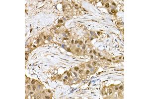 Immunohistochemistry of paraffin-embedded human breast cancer using ERK1/2 Rabbit mAb (ABIN7268620) at dilution of 1:100 (40x lens).