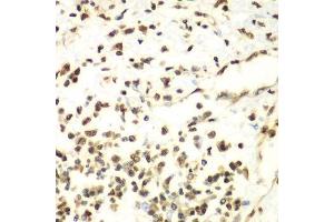 Immunohistochemistry of paraffin-embedded human liver cancer using HDAC2 antibody. (HDAC2 anticorps  (C-Term))