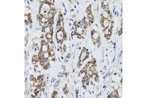 Immunohistochemistry of paraffin-embedded human colon carcinoma using SURF1 antibody (ABIN2560237) at dilution of 1:100 (40x lens). (SURF1 anticorps)