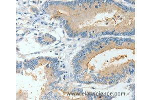 Immunohistochemistry of Human colon cancer using BAAT Polyclonal Antibody at dilution of 1:30 (BAAT anticorps)