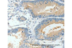 Immunohistochemistry of Human colon cancer using BAAT Polyclonal Antibody at dilution of 1:30