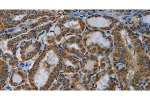Immunohistochemistry of paraffin-embedded Human thyroid cancer using NDUFA5 Polyclonal Antibody at dilution of 1:60 (NDUFA5 anticorps)