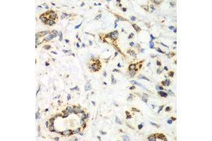 Immunohistochemistry of paraffin-embedded human liver cancer using NRBF2 antibody. (NRBF2 anticorps  (AA 10-220))