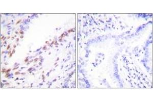 Immunohistochemistry analysis of paraffin-embedded human lung carcinoma tissue, using Ki67 Antibody. (Ki-67 anticorps  (AA 3207-3256))