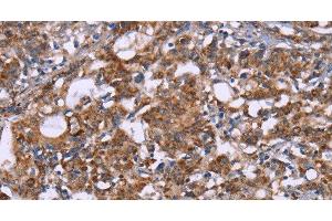 Immunohistochemistry of paraffin-embedded Human gastric cancer tissue using HSP10 Polyclonal Antibody at dilution 1:40 (HSPE1 anticorps)