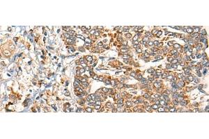 Immunohistochemistry of paraffin-embedded Human liver cancer tissue using EPHA6 Polyclonal Antibody at dilution of 1:40(x200) (EPH Receptor A6 anticorps)