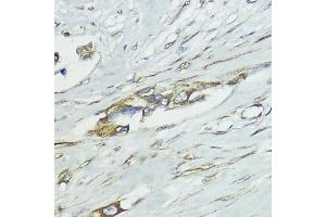 Immunohistochemistry of paraffin-embedded human lung cancer using SOCS5 antibody (ABIN6128734, ABIN6148271, ABIN6148272 and ABIN6223959) at dilution of 1:100 (40x lens).