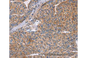 Immunohistochemistry of Human colon cancer using CDC7 Polyclonal Antibody at dilution of 1:70 (CDC7 anticorps)