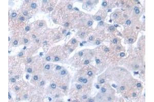 Detection of GbL in Human Liver cancer Tissue using Polyclonal Antibody to G Protein Beta Subunit Like Protein (GbL)