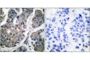 Immunohistochemistry analysis of paraffin-embedded human breast carcinoma, using eEF2 (Phospho-Thr56) Antibody. (EEF2 anticorps  (pThr56))