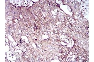 Immunohistochemical analysis of paraffin-embedded esophageal cancer tissues using CD6 mouse mAb with DAB staining. (CD6 anticorps  (AA 18-199))