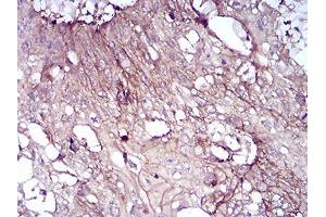 Immunohistochemical analysis of paraffin-embedded esophageal cancer tissues using CD6 mouse mAb with DAB staining.