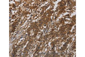 Immunohistochemistry of Human gastric cancer using ITGB7 Polyclonal Antibody at dilution of 1:40 (Integrin beta 7 anticorps)