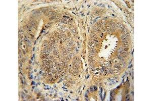 Anti-MDM2 antibody immunohistochemistry analysis in formalin fixed and paraffin embedded human prostate cancer.
