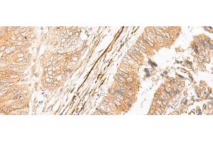 Immunohistochemistry of paraffin-embedded Human colorectal cancer tissue using EPS15 Polyclonal Antibody at dilution of 1:50(x200) (EPS15 anticorps)