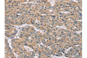 The image on the left is immunohistochemistry of paraffin-embedded Human liver cancer tissue using ABIN7192155(RBM38 Antibody) at dilution 1/35, on the right is treated with synthetic peptide. (RBM38 anticorps)