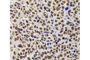 Immunohistochemistry of paraffin-embedded Mouse tumor using PHIP Polyclonal Antibody at dilution of 1:100 (40x lens).