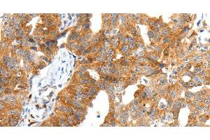 Immunohistochemistry of paraffin-embedded Human ovarian cancer tissue using SCT Polyclonal Antibody at dilution 1:40 (Secretin anticorps)