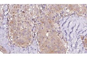 ABIN6273335 at 1/100 staining Human thyroid cancer tissue by IHC-P. (TRPC4AP anticorps  (N-Term))