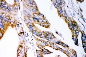 IHC-P: Claudin 2 antibody testing of human intestinal cancer tissue (Claudin 2 anticorps  (AA 38-230))