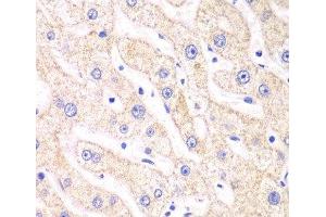 Immunohistochemistry of paraffin-embedded Human liver damage using PSMF1 Polyclonal Antibody at dilution of 1:100 (40x lens). (PSMF1 anticorps)