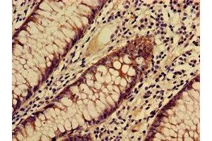 Immunohistochemistry of paraffin-embedded human colon cancer using ABIN7171891 at dilution of 1:100 (Tspan-8 anticorps  (AA 110-205))