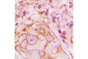 Immunohistochemical analysis of GPR105 staining in human breast cancer formalin fixed paraffin embedded tissue section.
