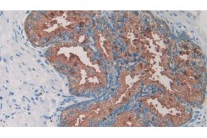 Detection of 0 in Human Prostate Tissue using Monoclonal Antibody to Amylin (Amylin/DAP anticorps)