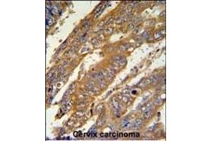 N3 Antibody (C-term) (ABIN651149 and ABIN2840100) IHC analysis in formalin fixed and raffin embedded human cervix carcinoma followed by peroxidase conjugation of the secondary antibody and DAB staining. (PAN3 anticorps  (C-Term))