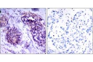 Immunohistochemistry analysis of paraffin-embedded human breast carcinoma tissue, using BCL-XL (Ab-62) Antibody. (BCL2L1 anticorps  (AA 28-77))