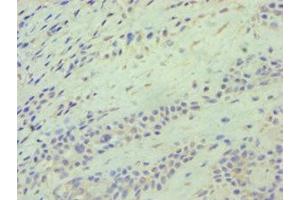 Immunohistochemistry of paraffin-embedded human breast cancer using ABIN7145117 at dilution of 1:100