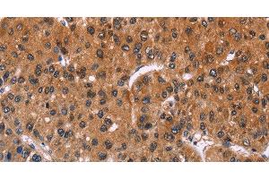 Immunohistochemistry of paraffin-embedded Human liver cancer using ING2 Polyclonal Antibody at dilution of 1:40