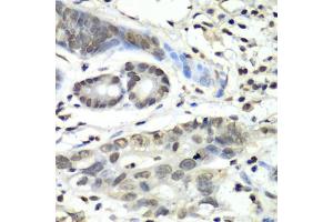 Immunohistochemistry of paraffin-embedded human gastric cancer using HIF1AN antibody (ABIN5973179) at dilution of 1/100 (40x lens). (HIF1AN anticorps)