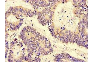 Immunohistochemistry of paraffin-embedded human colon cancer using ABIN7169300 at dilution of 1: 100 (PGAM5 anticorps  (AA 30-223))