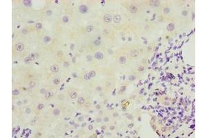 Immunohistochemistry of paraffin-embedded human liver cancer using ABIN7151406 at dilution of 1:100 (EFCAB12 anticorps  (AA 1-200))